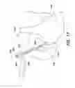 Fig. 20 - Method and apparatus for performing anterior hip surgery