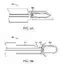 Fig. 06 - INTRAOCULAR LENS PERIPHERAL SURGICAL SYSTEMS