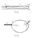 Fig. 15 - INTRAOCULAR LENS PERIPHERAL SURGICAL SYSTEMS
