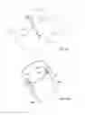 Fig. 23 - Device and method for endoluminal therapy