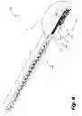 Fig. 07 - Intraneural Implant
