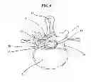 Fig. 09 - METHODS AND DEVICES FOR COOLING SPINAL TISSUE