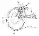 Fig. 04 - Self-administrable method, system and apparatus  for non-invasive neurostimulation therapy of the brain