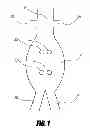 Fig. 02 - Stent graft