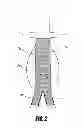 Fig. 03 - Stent graft
