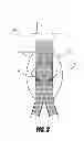 Fig. 04 - Stent graft