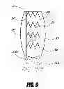 Fig. 07 - Stent graft