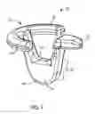 Fig. 02 - Graft fixation