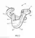Fig. 03 - Graft fixation