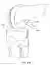 Fig. 37 - Graft fixation