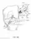 Fig. 40 - Graft fixation