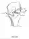 Fig. 41 - Graft fixation