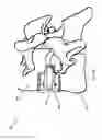 Fig. 09 - METHODS AND APPARATUS FOR AN OSTEOTOMY FIXATION OR ARTHRODESIS CAGE