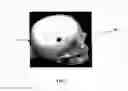 Fig. 02 - Bioabsorbable plug implants and method for bone tissue regeneration