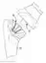 Fig. 01 - Shoulder prosthesis