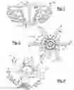 Fig. 02 - Shoulder prosthesis