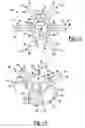 Fig. 06 - Shoulder prosthesis