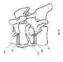 Fig. 06 - METHODS AND APPARATUS FOR A MULTIPLE TRANSITION TEMPERATURE IMPLANT