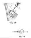 Fig. 03 - Implants and biodegradable fiducial markers