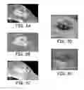 Fig. 04 - Implants and biodegradable fiducial markers