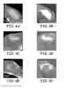 Fig. 05 - Implants and biodegradable fiducial markers