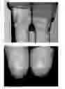 Fig. 02 - METHODS FOR REDUCING OR ALTERING SCAR FORMATION