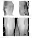 Fig. 03 - METHODS FOR REDUCING OR ALTERING SCAR FORMATION