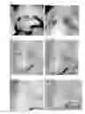 Fig. 05 - METHODS FOR REDUCING OR ALTERING SCAR FORMATION