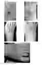 Fig. 07 - METHODS FOR REDUCING OR ALTERING SCAR FORMATION