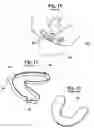 Fig. 05 - METHOD FOR MAKING AN IMPRESSION TRAY FOR DENTAL USE