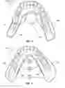 Fig. 03 - Stabilizer for lower dental appliances