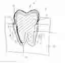 Fig. 01 - Implantable replica of natural tooth