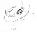Fig. 02 - Implantable replica of natural tooth