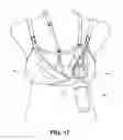 Fig. 18 - Pumping/nursing bra