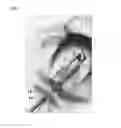 Fig. 02 - Length adjustable cannula