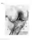 Fig. 04 - Length adjustable cannula