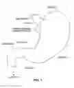 Fig. 02 - Gastro-esophageal implants