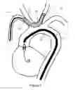 Fig. 02 - Methods and devices for embolic protection