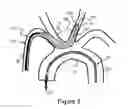 Fig. 07 - Methods and devices for embolic protection