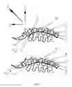 Fig. 06 - System for dynamically adjusting treatment angle under tension to accommodate variations in spinal morphology
