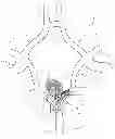 Fig. 01 - Protuberant aneurysm bridging device and method of use