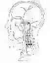 Fig. 02 - Protuberant aneurysm bridging device and method of use