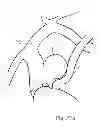 Fig. 33 - Protuberant aneurysm bridging device and method of use