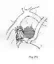 Fig. 35 - Protuberant aneurysm bridging device and method of use