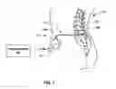 Fig. 02 - Determining vertical axis scale for implantable fluid delivery system