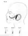 Fig. 03 - Facial structure stabilization methods and apparatus
