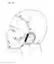 Fig. 11 - Facial structure stabilization methods and apparatus