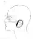 Fig. 15 - Facial structure stabilization methods and apparatus