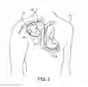 Fig. 02 - Planar transformer assemblies for implantable cardioverter defibrillators