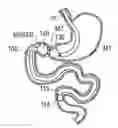 Fig. 01 - Digestive tract device